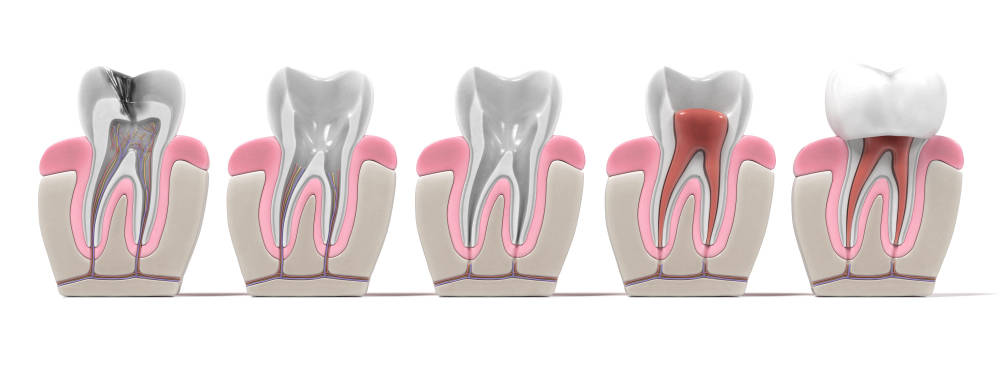 Procedimiento endodoncia en Clínica dental Bayona