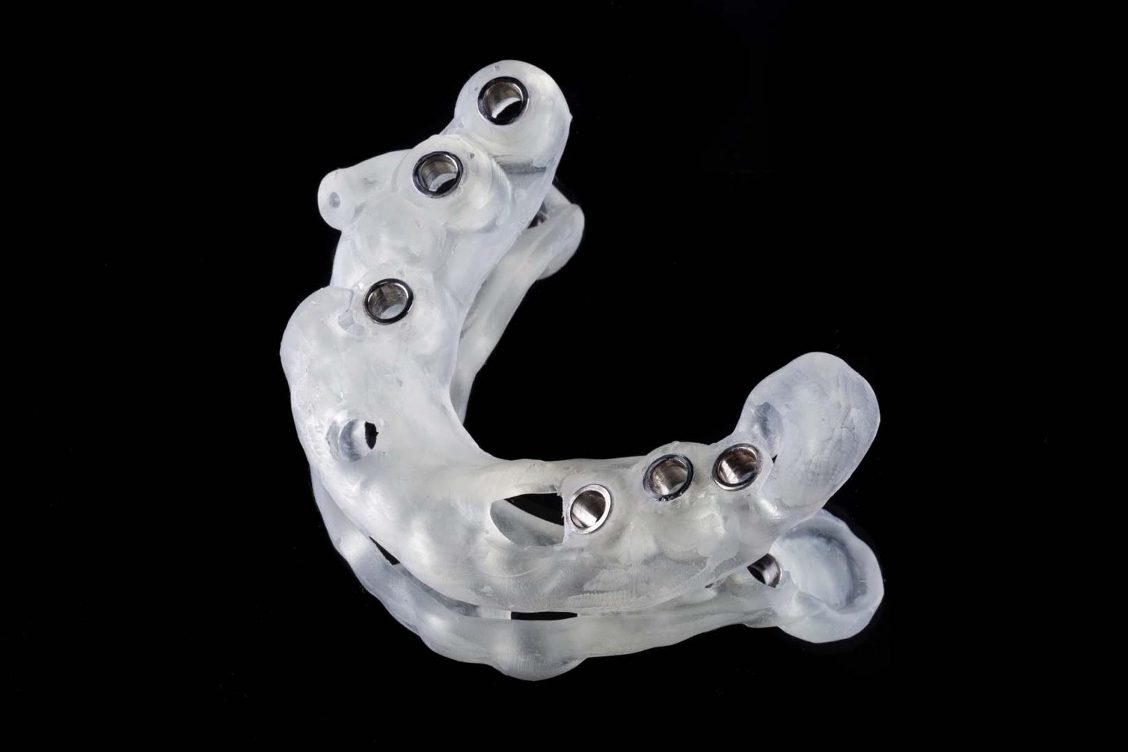 Tecnología 3D al servicio de la colocación de implantes. ¿Qué es la cirugía guiada?